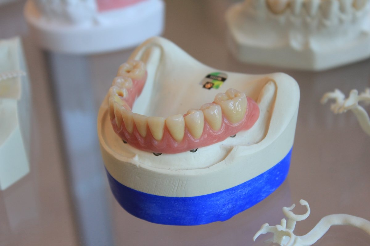 An implant-supported denture on a dental model